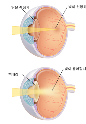 수정체가 빛에 선명하게 초점을 맞추고 있는 것을 보여주는 눈의 3/4 모습. 백내장이 빛을 산란시키는 것을 보여주는 눈의 3/4 모습.