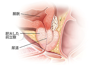 肥大した前立腺の断面図。