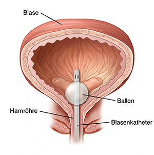 Querschnitt einer Blase mit platziertem Blasenkatheter.