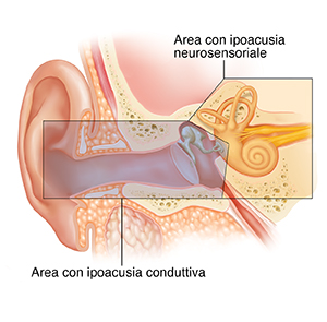 Sezione trasversale di un orecchio con le sue strutture esterne, interne e medie in evidenza. La sovrapposizione di colore mostra le aree che causano ipoacusia conduttiva e neurosensoriale.