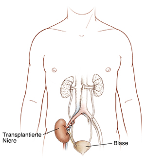 Vorderansicht eines männlichen Körpers mit Harnwegen und transplantierter Niere.