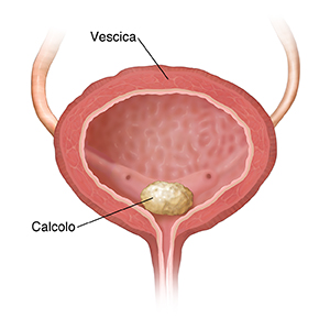 Sezione trasversale della vescica con calcoli alla vescica in evidenza.