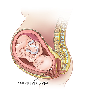 두껍고 막힌 상태의 자궁경관을 보여 주는 자궁 내 태아의 측면 모습.