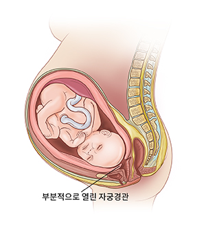 조기 산통 시 얇아져 열리기 시작하는 자궁경관을 보여주는 자궁 내 태아의 측면 모습.