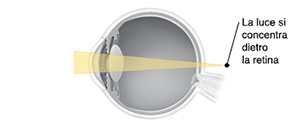 Sezione trasversale di un occhio con la luce concentrata dietro alla retina.
