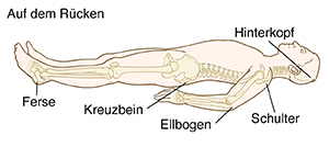 Schematische Darstellung einer liegenden Person mit dargestellten Knochen. Druckpunkte: Hinterkopf, Schulter, Ellbogen, Kreuzbein und Ferse.