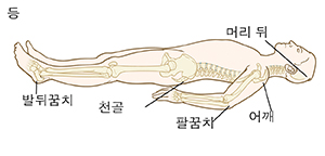 뼈가 보이는 상태로 등을 대고 누워 있는 사람의 대략적 모습. 압통점: 머리 뒤, 어깨, 팔꿈치, 천골 및 발뒤꿈치.