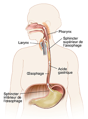 Schéma d'une femme montrant la bouche, l'œsophage et l'estomac. Les flèches montrent l'acide gastrique remontant dans l'œsophage pour irriter l'arrière de la gorge.