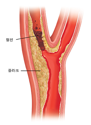 플라크가 쌓이고 혈전이 보이는 경동맥의 단면도.