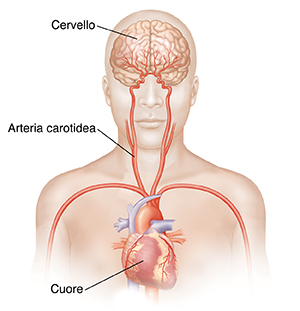 Vista frontale di una testa e della parte superiore del corpo con le arterie carotidi e il cervello in evidenza.