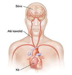 Yon imaj fas tèt la ak anwo kò a k ap montre atè kawotid yo ak sèvo a.