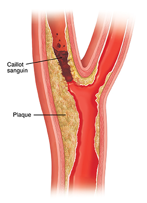 Coupe transversale d'une artère carotide saine montrant l'accumulation de plaque et des caillots sanguins.