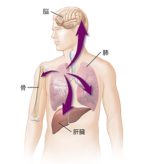 肝臓、他の肺、骨、脳に広がる肺がんを示す矢印の付いた男性像の略図。