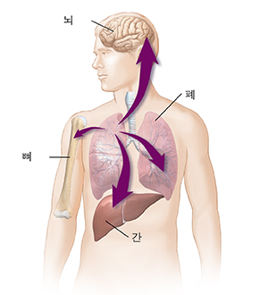 화살표로 폐암이 간, 반대쪽 폐, 뼈, 뇌로 퍼져나가는 모습을 보여주는 남성의 대략적 모습.