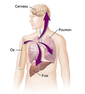Schéma d'un homme avec des flèches montrant le cancer du poumon se propageant au foie, à l'autre poumon, aux os et au cerveau.