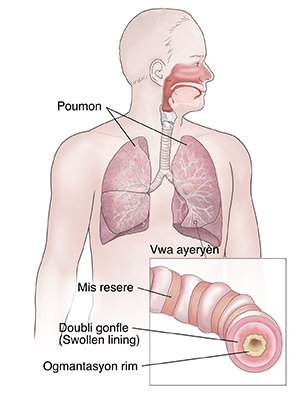 Imaj fas yon nèg la k ap montre sistèm respirstwa a. Anka a (l'ancart) montre vwa respiratwa ki anfe yo.