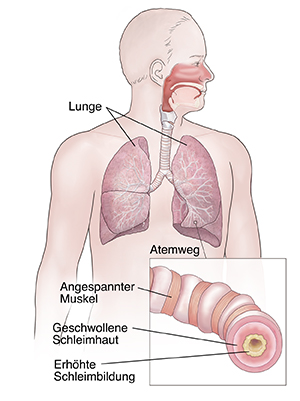 Vorderansicht eines Mannes mit Atemwegssystem. Eingeblendetes Bild zeigt entzündete Atemwege.