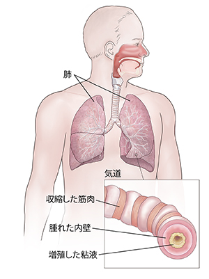 呼吸器系を示す男性の正面図。挿入図は、炎症を起こした気道を示しています。