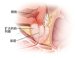 扩大的前列腺的横截面。