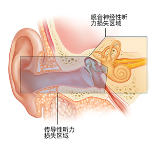 显示外耳、内耳和中耳结构的耳朵横截面。颜色叠加显示导致传导性和感音神经性听力损失的区域。