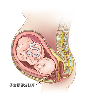 显示早产中子宫颈开始变薄和打开的子宫中胎儿的侧视图。