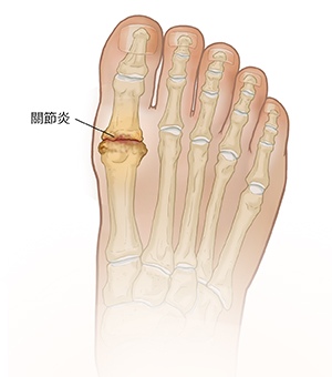 足部俯視圖,顯示大腳趾關節的關節炎。