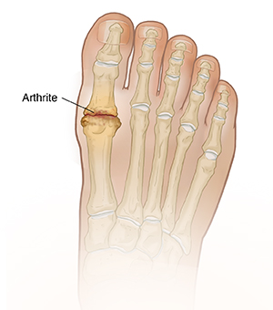 Vue de dessus du pied montrant l'arthrite dans l'articulation du gros orteil.