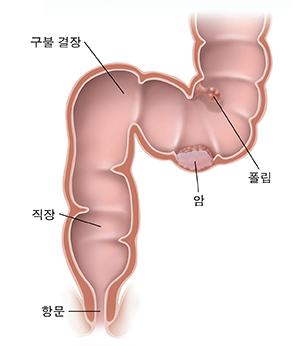 암과 폴립이 보이는 구불결장, 직장과 항문의 단면도.