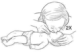 Mujer con las manos en la barbilla y la cabeza de un niño pequeño acostado boca arriba con la cabeza inclinada hacia atrás. Una mujer cubre la cara y la nariz del bebé con su boca para hacerle respiración de rescate.