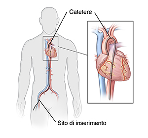 Vista frontale di un uomo che mostra il catetere inserito nell'arteria dell'inguine. L'inserto mostra un catetere nel cuore.
