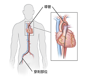 顯示導管插入腹股溝動脈的男性前視圖。插圖顯示導管在心臟內。