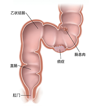 显示患有癌症和长有息肉的乙状结肠、直肠和肛门的横截面。