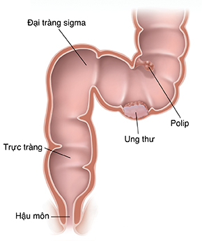 Mặt cắt của đại tràng sigma, trực tràng và hậu môn thể hiện ung thư và polyp.