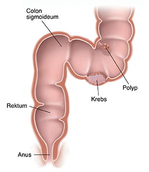 Querschnitt von Colon sigmoideum, Rektum und Anus mit Anzeichen von Krebs und Polyp.