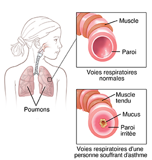 Schéma d'un enfant montrant le système respiratoire. Images en médaillon des voies respiratoires normales et des voies respiratoires d'une personne souffrant d'asthme.