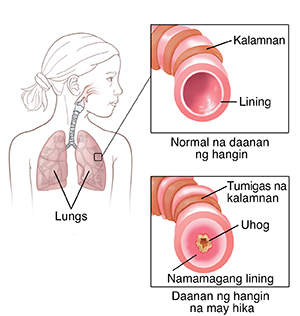 Balangkas ng bata na ipinapakita ang sistema ng palahingahan. Ipinapakita sa mga inset ang normal na daanan ng hangin at daanan ng hangin na may hika.