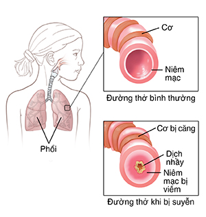 Hình minh họa đứa trẻ cho thấy hệ thống hô hấp. Hình nhỏ cho thấy đường thở bình thường và đường thở khi bị suyễn.