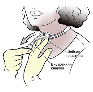 Женщина, удаляющая трахеостомическую трубку из шеи.