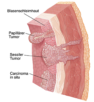Querschnitt der Blasenwand mit Schleimhaut, Submukosa, Muskel, Fett und drei Arten von Krebs: papilläre Tumoren, sessile Tumoren und Carcinoma in situ.