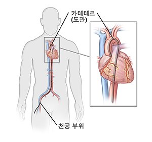 사타구니 동맥에 카테테르를 삽입한 상태인 남성의 앞 모습. 심장에 삽입된 카테테르를 보여주는 삽입 그림.