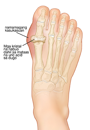 Itaas na kuha ng paa na ipinakikita ang mga buto ng paa na may pamamaga ng gout at mga uric acid na kristal.