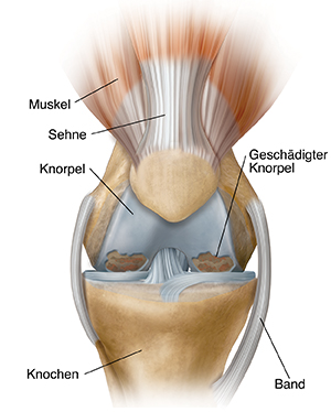 Vorderansicht eines Knies mit Osteoarthrose.