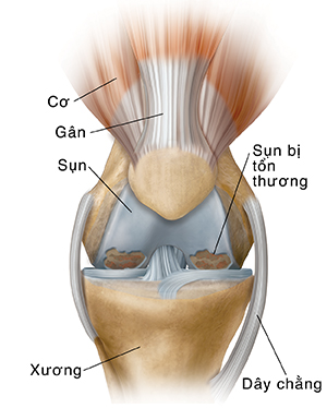 Mặt trước của đầu gối cho thấy viêm xương khớp.