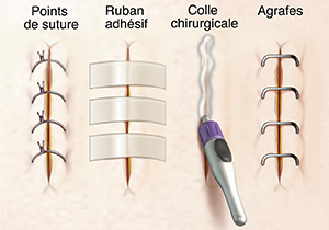 Quatre incisions fermées par des sutures, sutures cutanées adhésives, colle chirurgicale et agrafes.