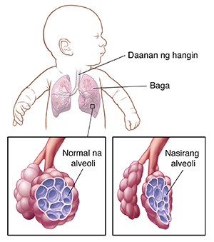 Sanggol na nakabaling ang ulo sa gilid na nagpapakita ng daanan ng hangin at mga baga. Closeup ng daanan ng hangin at normal na alveoli. Closeup ng daanan ng hangin at nasirang alveoli.