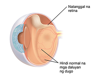 Cross section ng three-quarter view ng mata na ipinakikita ang retinopathy ng prematurity.