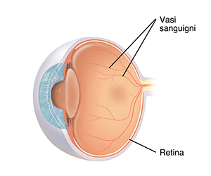 Sezione trasversale vista a tre quarti di un occhio che mostra vasi sanguigni normali sulla retina.