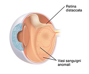 Sezione trasversale vista a tre quarti di un occhio che mostra retinopatia del prematuro.