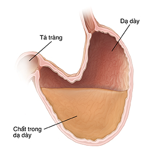 Mặt cắt của dạ dày và tá tràng. Bụng to và chảy xệ. Các chất trong dạ dày ở phần chùng xuống không thể di chuyển đúng cách ra khỏi dạ dày đến tá tràng.