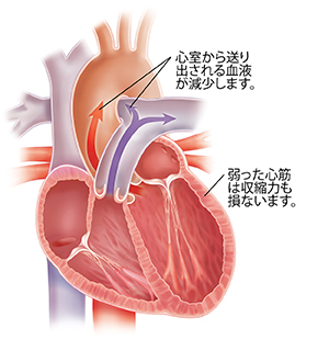 収縮期心不全により拡大した心臓の断面図。
